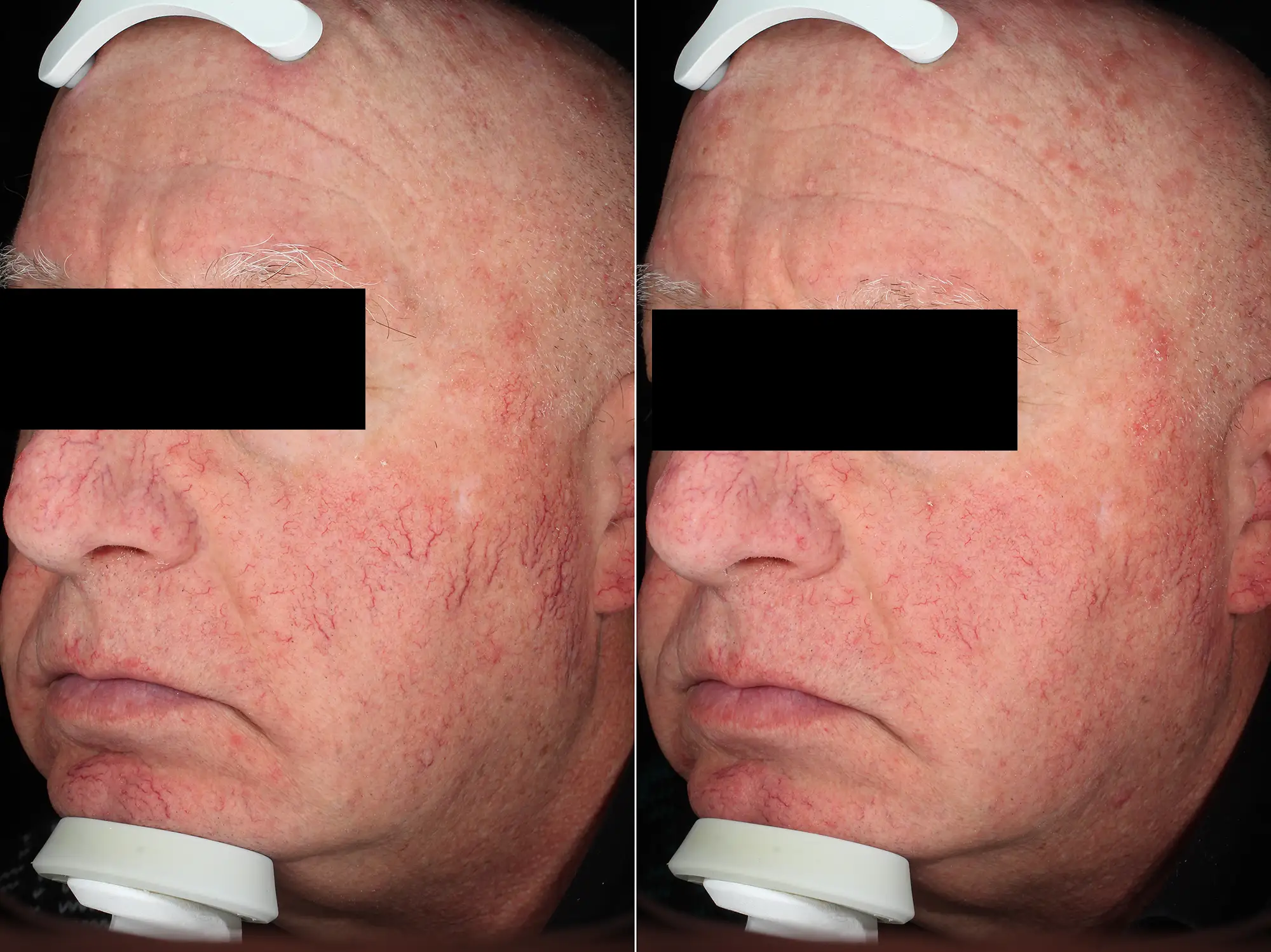 1 ND-YG1064, 1 SESSION