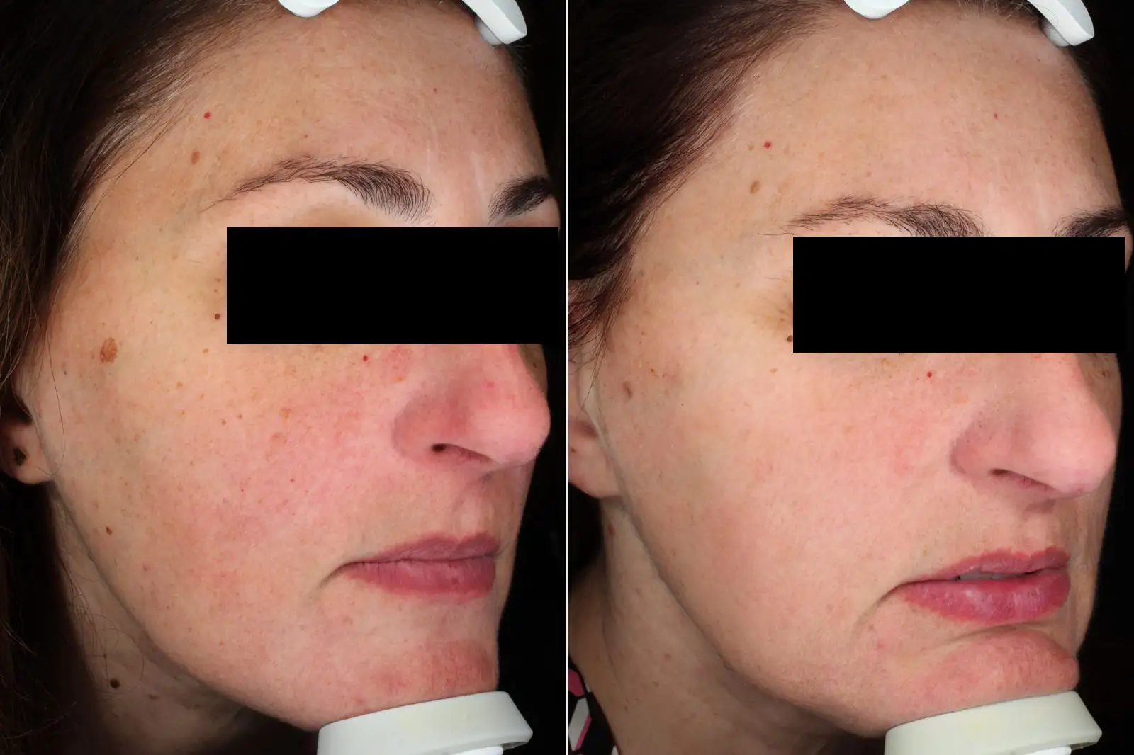 IPL 530 SMT, 1 SESSION