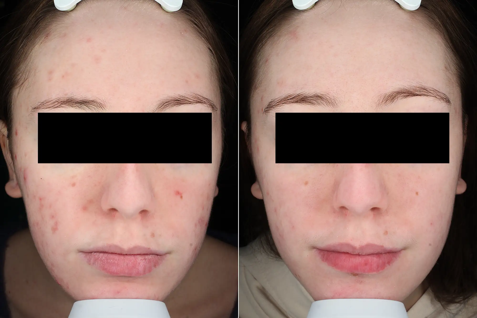 ACNE, IPL AC420