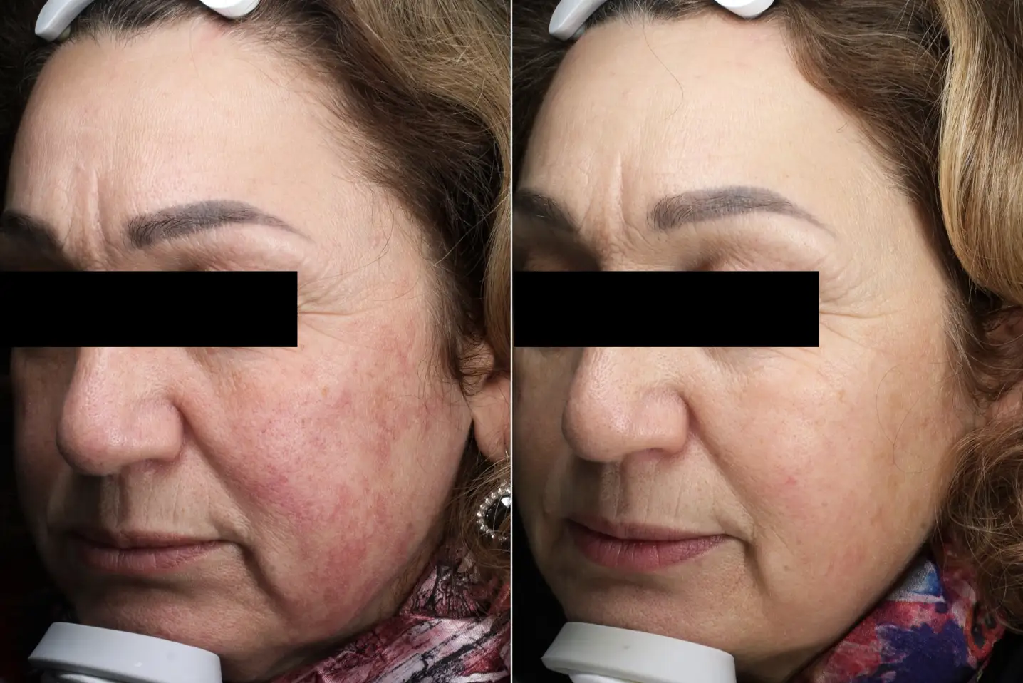 LATO SIN - IPL530SMT