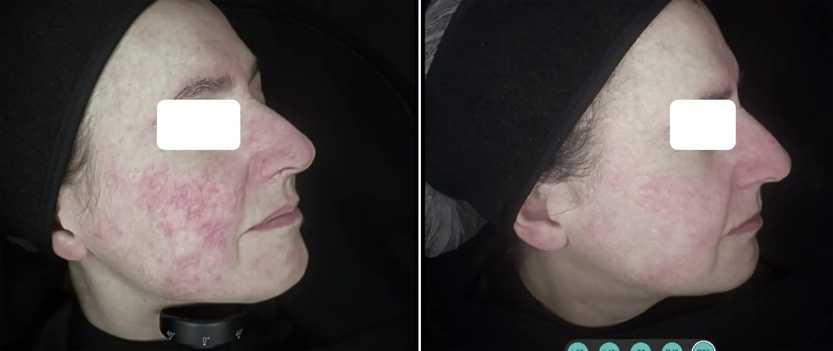 COMBINED PROTOCOL: IPL 530 SMT AND LASER 1064 LP