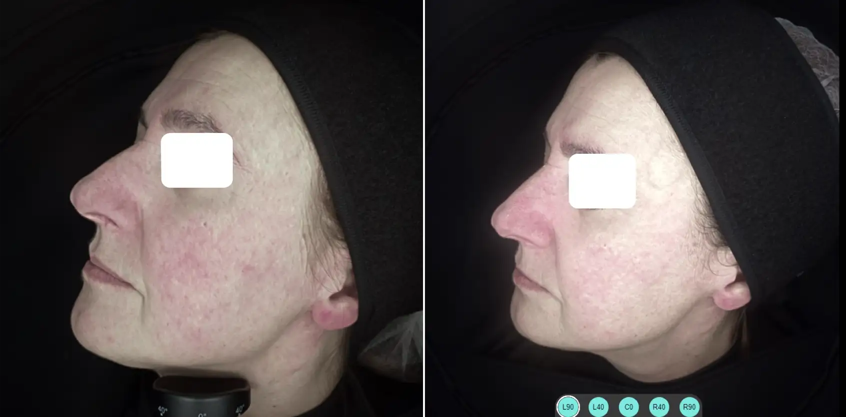 COMBINED PROTOCOL: IPL 530 SMT AND LASER 1064 LP