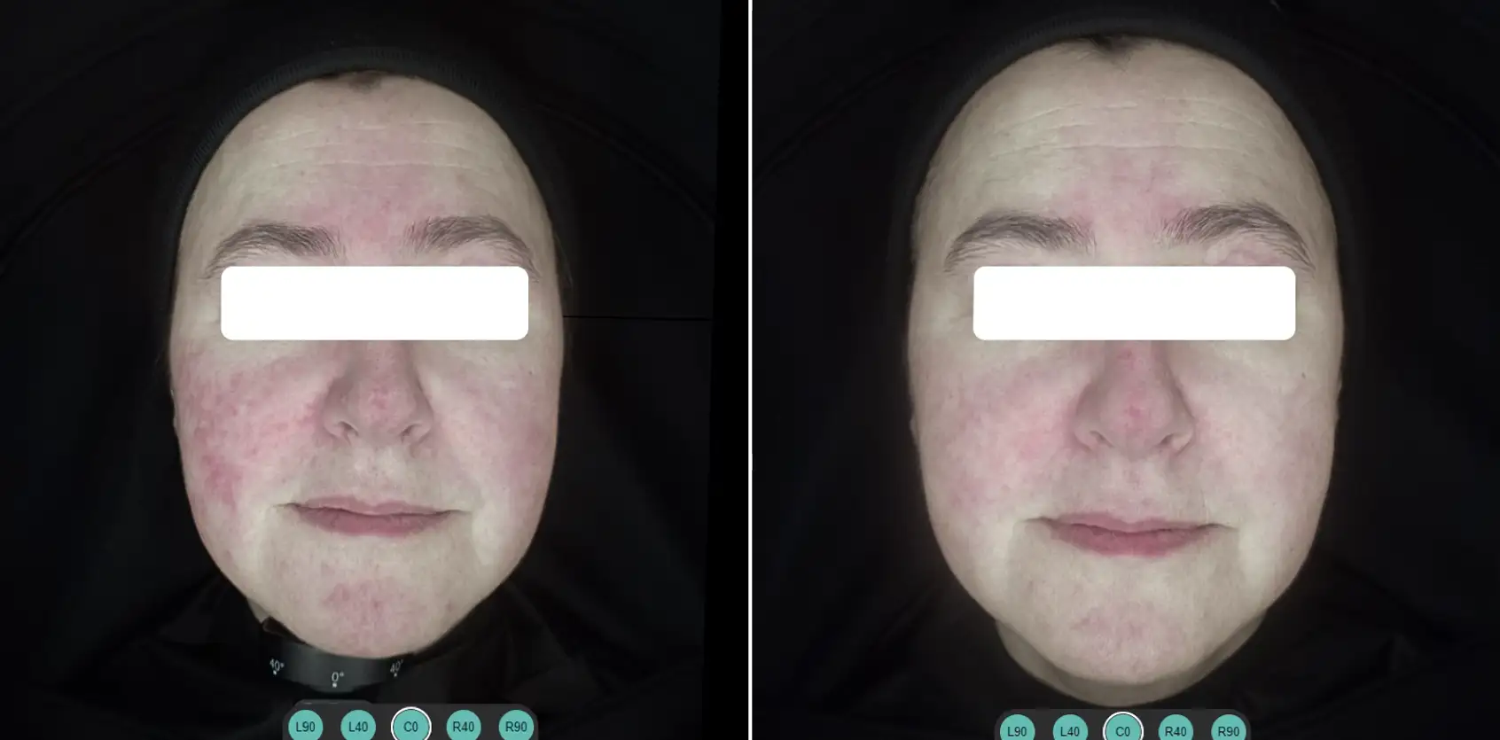 COMBINED PROTOCOL: IPL 530 SMT AND LASER 1064 LP